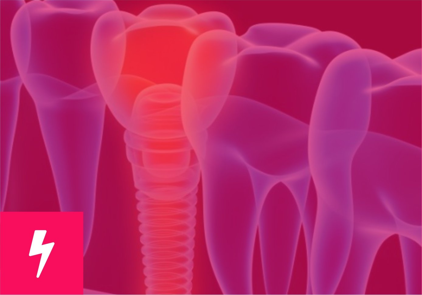 Reconstruções Teciduais e Cirurgia Avançada em Implantodontia